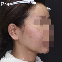 【40代女性・フェイスラインをスッキリ小顔に】フェイスリフト＋リガメント処理＋脂肪吸引（あご）（術後1ヶ月） Before 