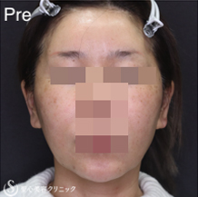 【40代女性・フェイスラインをスッキリ小顔に】フェイスリフト＋リガメント処理＋脂肪吸引（あご）（術後1ヶ月） Before 