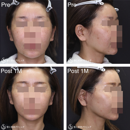 【40代女性・フェイスラインをスッキリ小顔に】フェイスリフト＋リガメント処理＋脂肪吸引（あご）（術後1ヶ月） After 