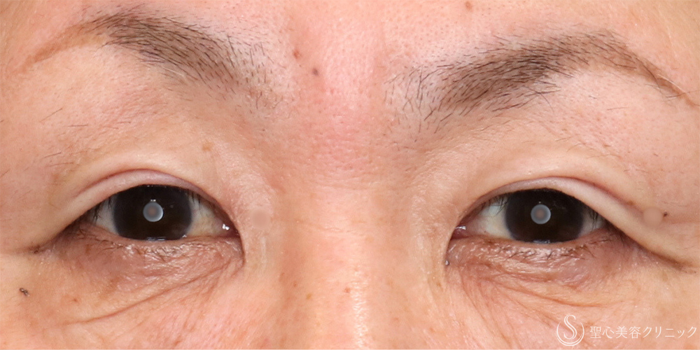 【50代女性・ぱっちり目元に】二重全切開術＋脂肪取り（2ヶ月後） Before 