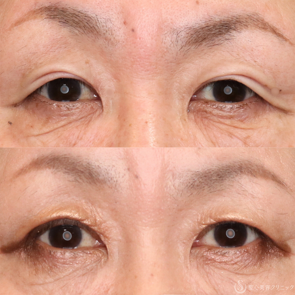 【50代女性・ぱっちり目元に】二重全切開術＋脂肪取り（2ヶ月後） After 名古屋・二重・ぱっちり二重・目のたるみ・目元たるみ
