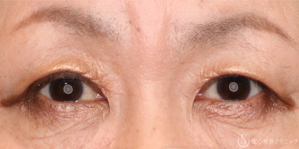 【50代女性・ぱっちり目元に】二重全切開術＋脂肪取り（2ヶ月後） After 