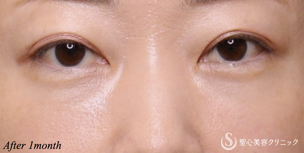 【40代女性・目の下の膨らみ】経結膜脱脂術（1ヶ月後） After 