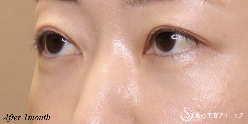 【40代女性・目の下の膨らみ】経結膜脱脂術（1ヶ月後） After 