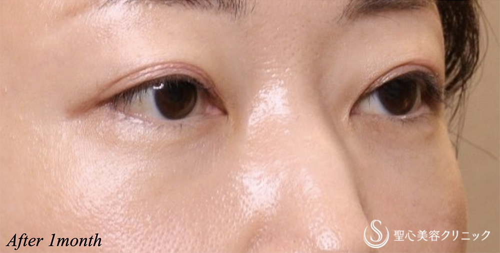 【40代女性・目の下の膨らみ】経結膜脱脂術（1ヶ月後） After 