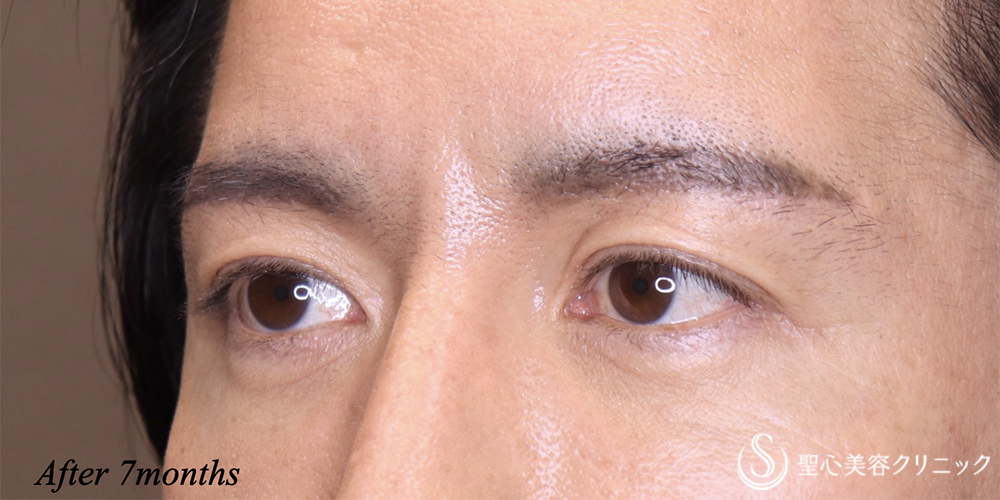 【40代男性・目元をスッキリ】眉下リフト（7ヶ月後） After 