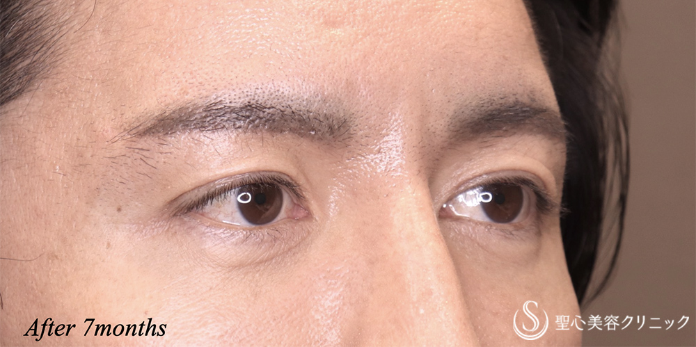 【40代男性・目元をスッキリ】眉下リフト（7ヶ月後） After 