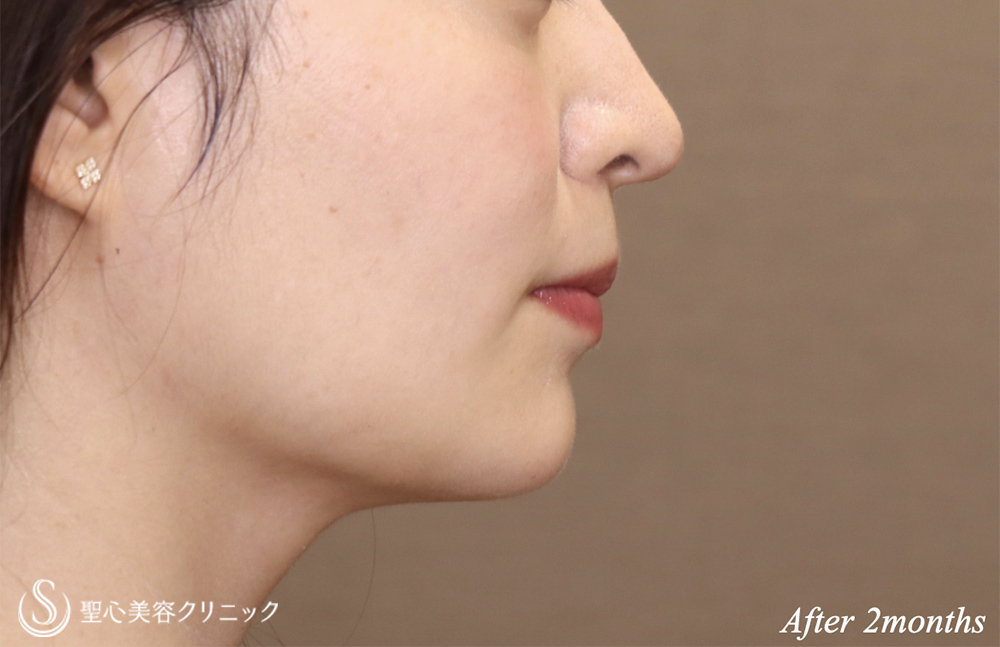 【30代女性・フェイスラインがすっきり】脂肪吸引注射（頬＋顎下）（2ヶ月後） After 