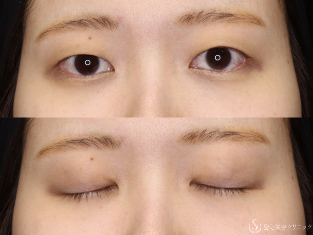 【30代女性・自然で綺麗な二重】二重術（切開法）＋眼窩脱脂（1ヶ月後） Before 