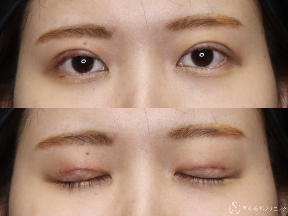 【30代女性・自然で綺麗な二重】二重術（切開法）＋眼窩脱脂（1ヶ月後） After 