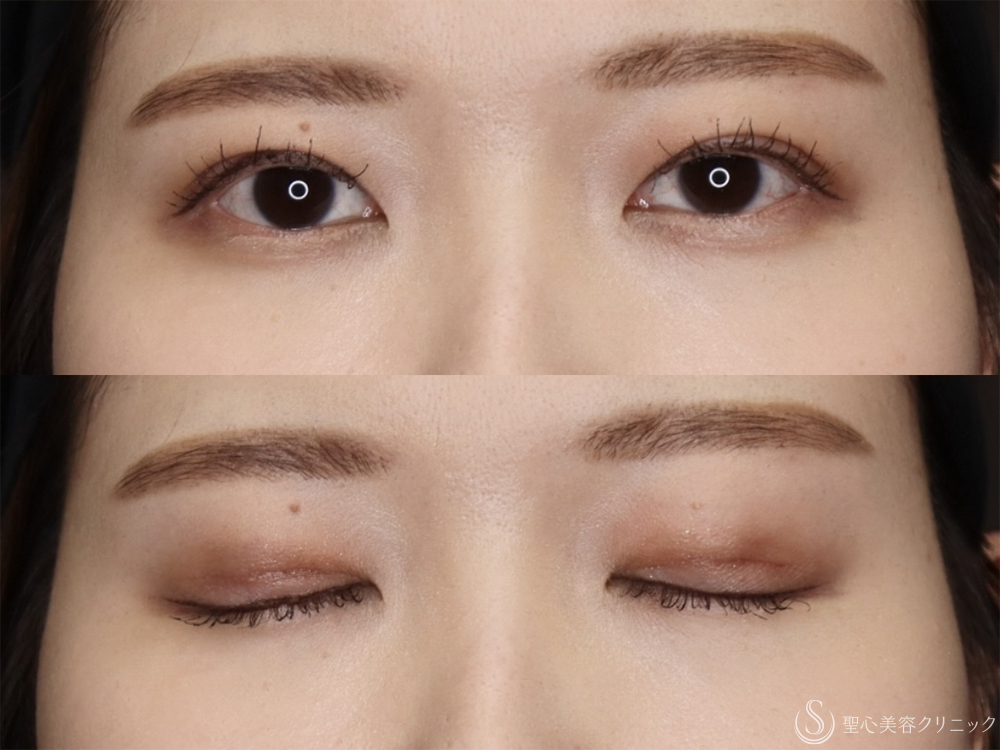 【30代女性・自然で綺麗な二重】二重術（切開法）＋眼窩脱脂（1ヶ月後） After 