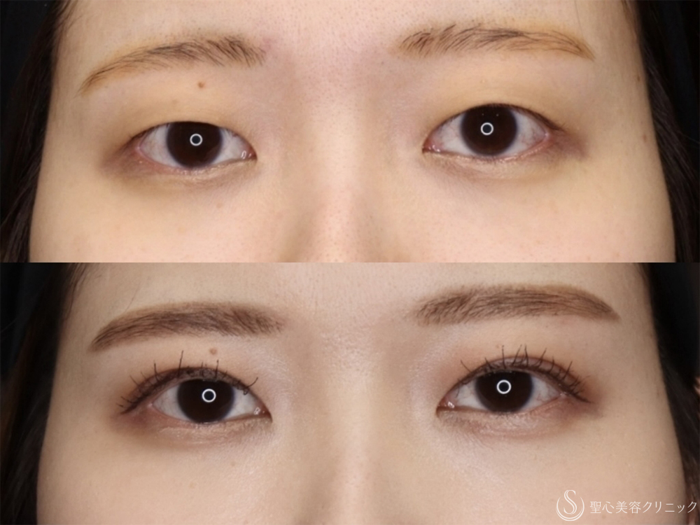 【30代女性・自然で綺麗な二重】二重術（切開法）＋眼窩脱脂（1ヶ月後） After 