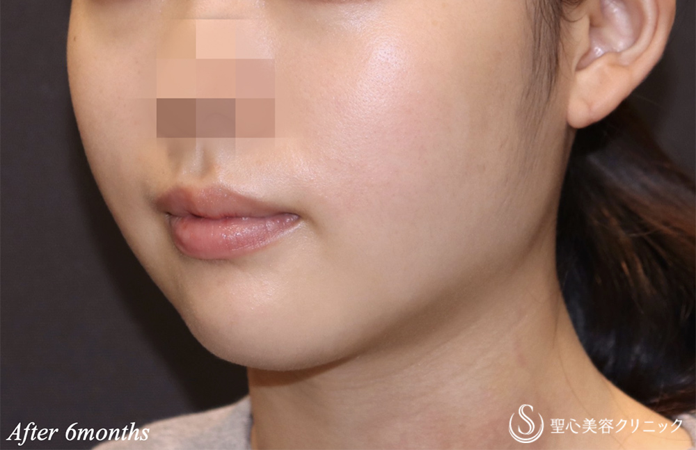 【20代女性・頬と顎下のもたつき】脂肪吸引注射（頬＋顎）（6ヵ月後） After 