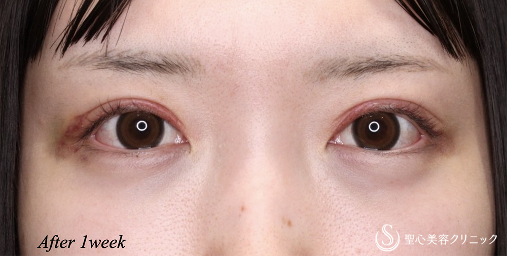 【20代女性・ハム目を解消】睫毛上皮膚切除（1週間後） After 