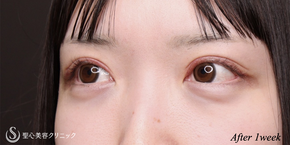【20代女性・ハム目を解消】睫毛上皮膚切除（1週間後） After 