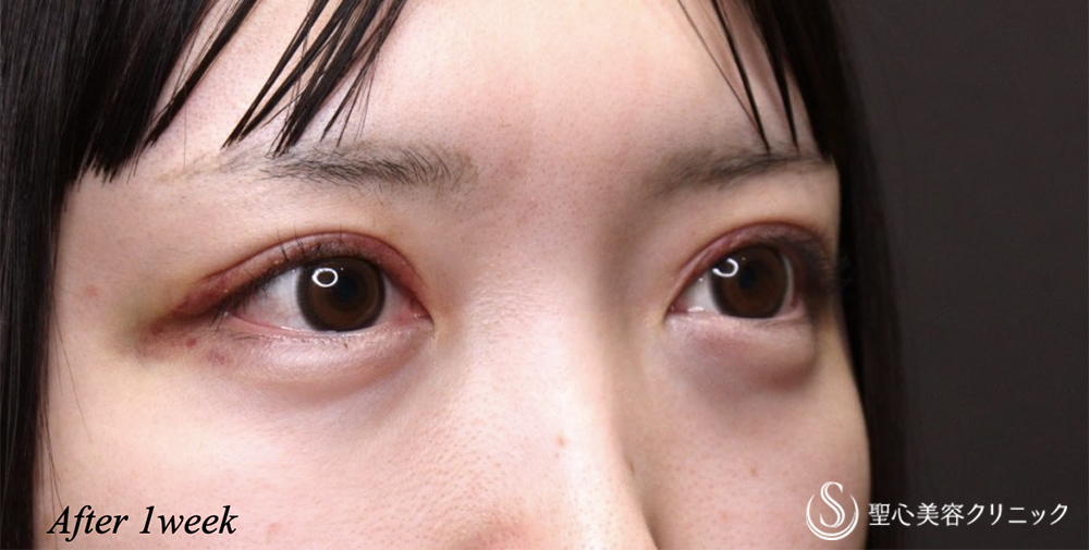 【20代女性・ハム目を解消】睫毛上皮膚切除（1週間後） After 