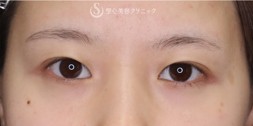 【20代女性・埋没法を卒業して一生モノの二重に】二重全切開（3ヶ月後） Before 