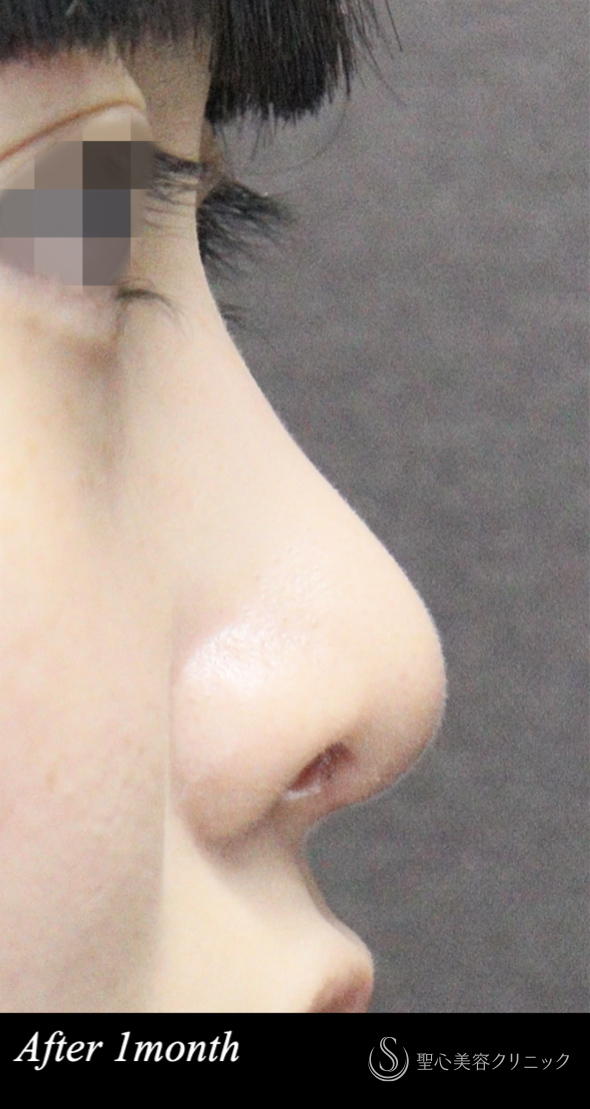 【20代女性・小さくナチュラルな鼻】　鼻尖形成（ストラット法）＋耳介軟骨移植後（1ヶ月後） After 