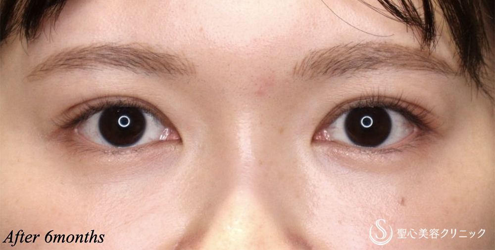 【20代女性・二重幅を自然に広げる】二重術（埋没法）マイクロメソッド+α（6ヶ月後） After 
