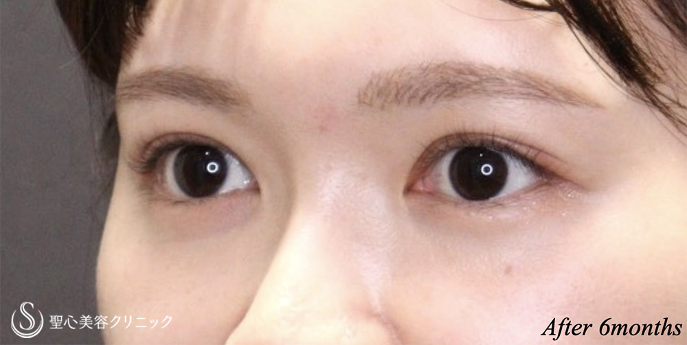 【20代女性・二重幅を自然に広げる】二重術（埋没法）マイクロメソッド+α（6ヶ月後） After 