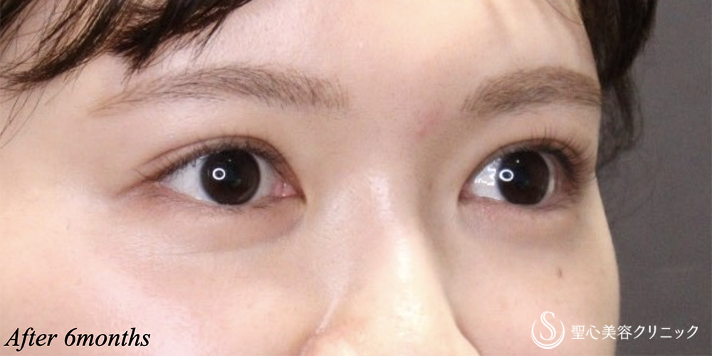 【20代女性・二重幅を自然に広げる】二重術（埋没法）マイクロメソッド+α（6ヶ月後） After 