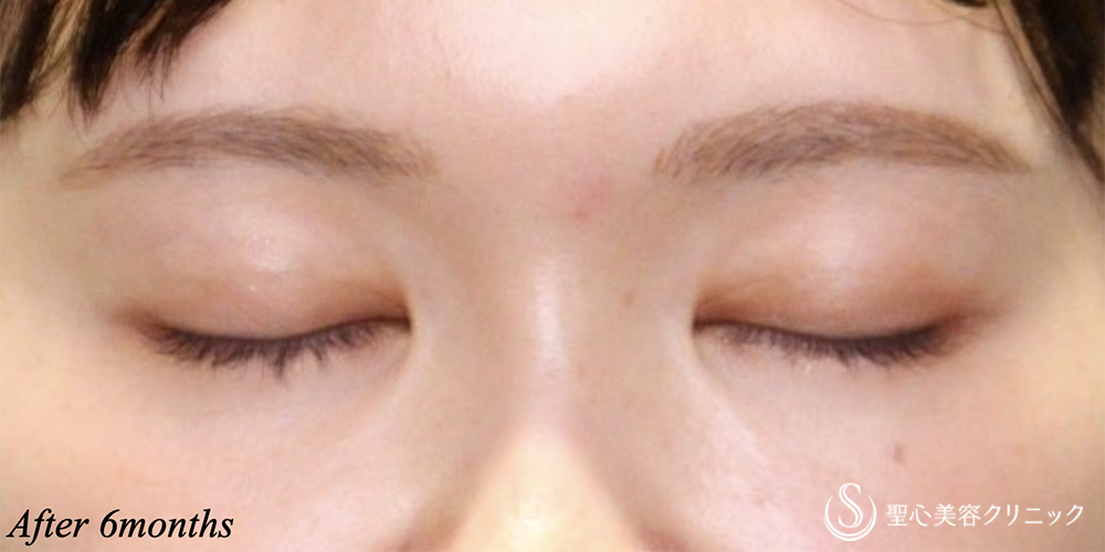 【20代女性・二重幅を自然に広げる】二重術（埋没法）マイクロメソッド+α（6ヶ月後） After 