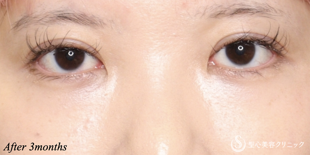 【20代女性・二重】二重術（切開法）（3ヶ月後） After 