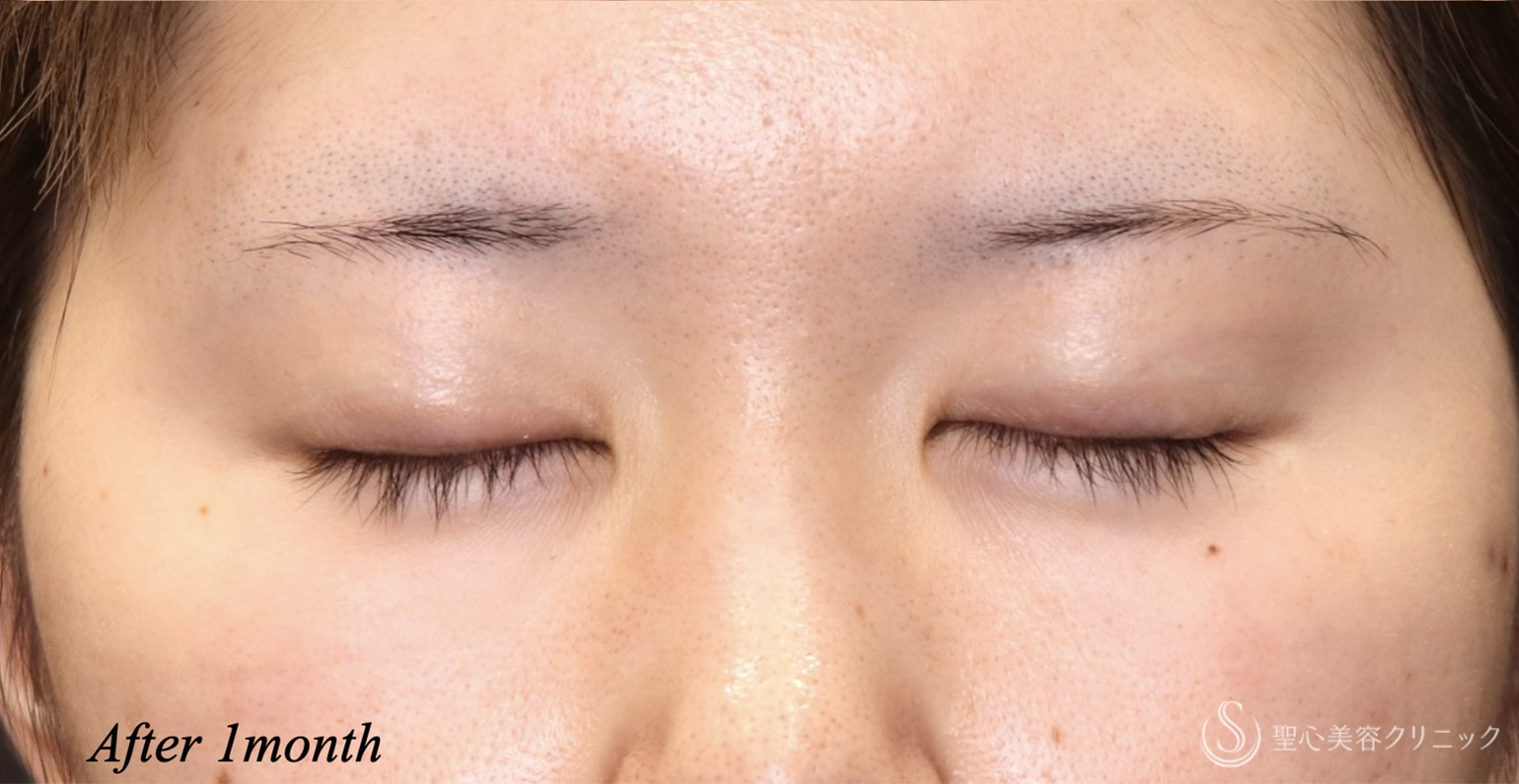 【20代女性・ハム目を治す】睫毛上皮膚切除（術後1ヶ月） After 
