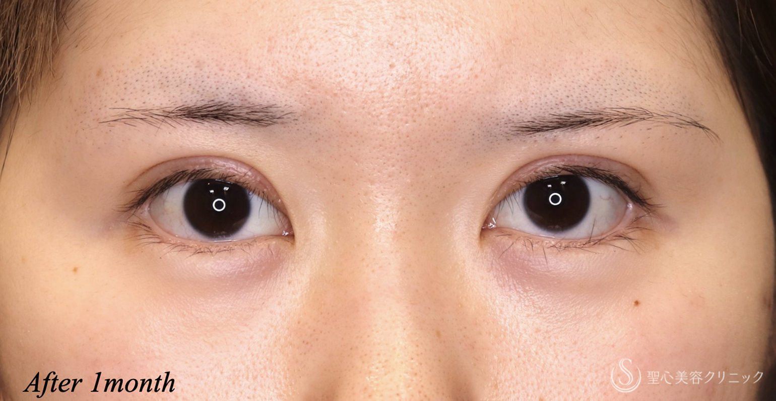【20代女性・ハム目を治す】睫毛上皮膚切除（術後1ヶ月） After 