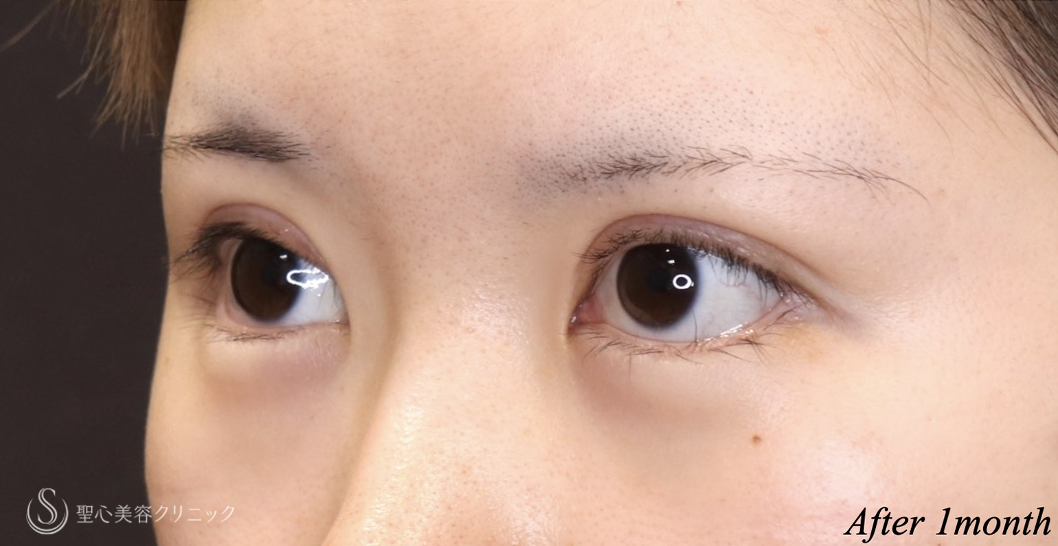 【20代女性・ハム目を治す】睫毛上皮膚切除（術後1ヶ月） After 
