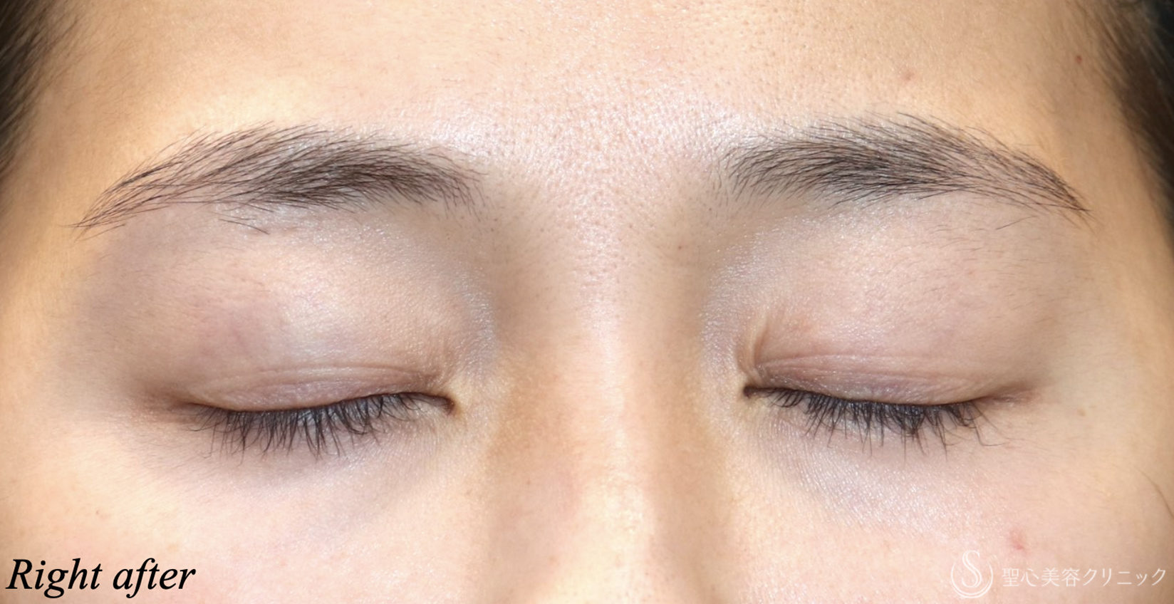 【20代女性・目の開きを大きく】　眼瞼下垂（埋没法）（直後） After 