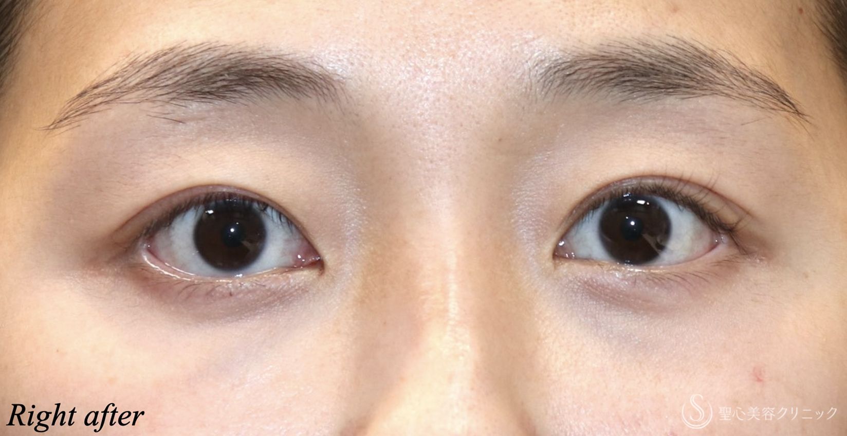 【20代女性・目の開きを大きく】　眼瞼下垂（埋没法）（直後） After 