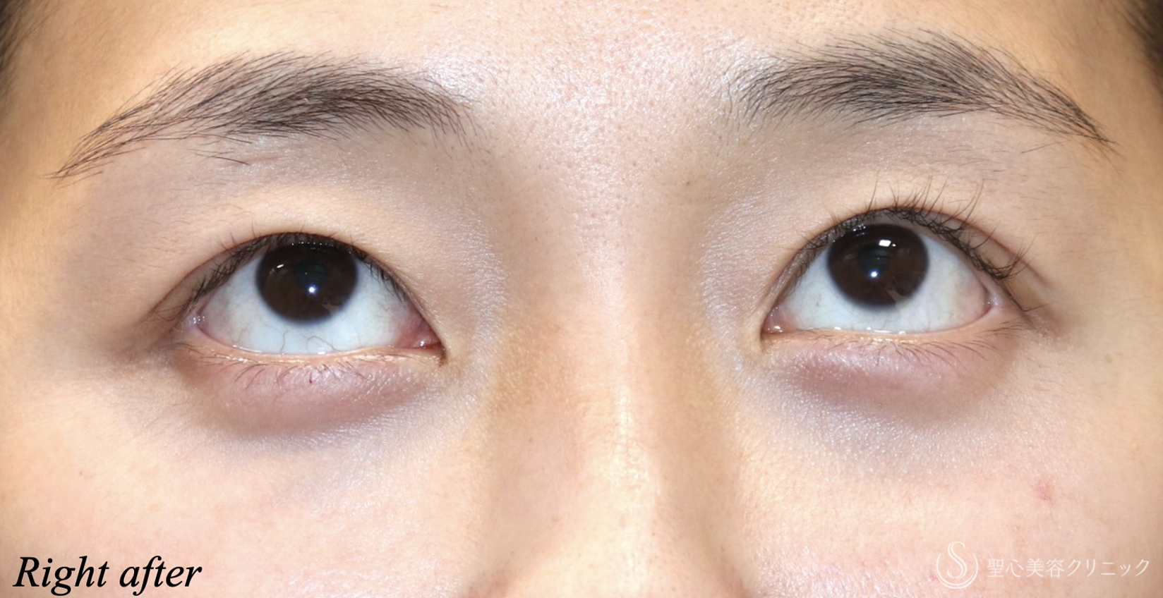 【20代女性・目の開きを大きく】　眼瞼下垂（埋没法）（直後） After 