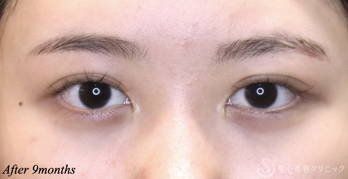 【20代女性・二重幅を自然に広げたい】目上切開(埋没法)(術後9ヶ月)