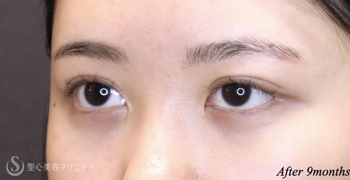 【20代女性・二重幅を自然に広げたい】目上切開（埋没法）（術後9ヶ月） After 