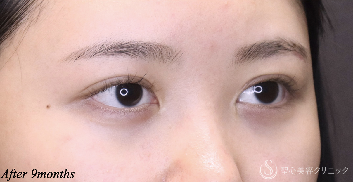 【20代女性・二重幅を自然に広げたい】目上切開（埋没法）（術後9ヶ月） After 