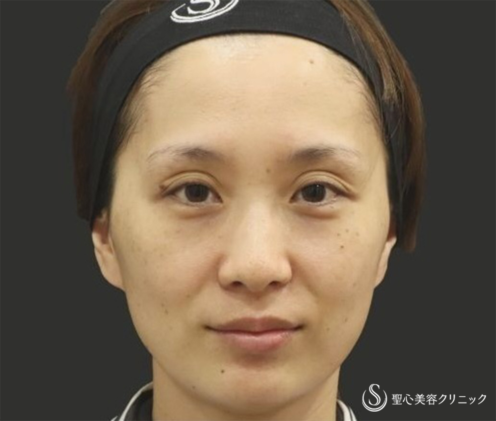 【30代女性・自然な若返り】プレミアムPRP再生療法（翌日～3ヶ月後） Before 