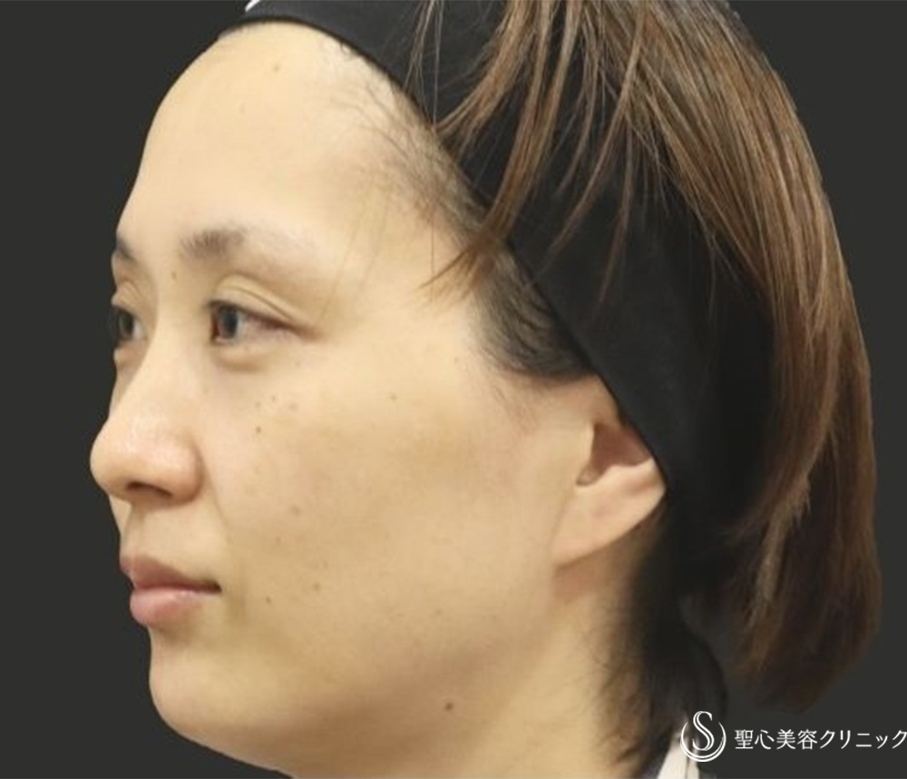 【30代女性・自然な若返り】プレミアムPRP再生療法（翌日～3ヶ月後） Before 