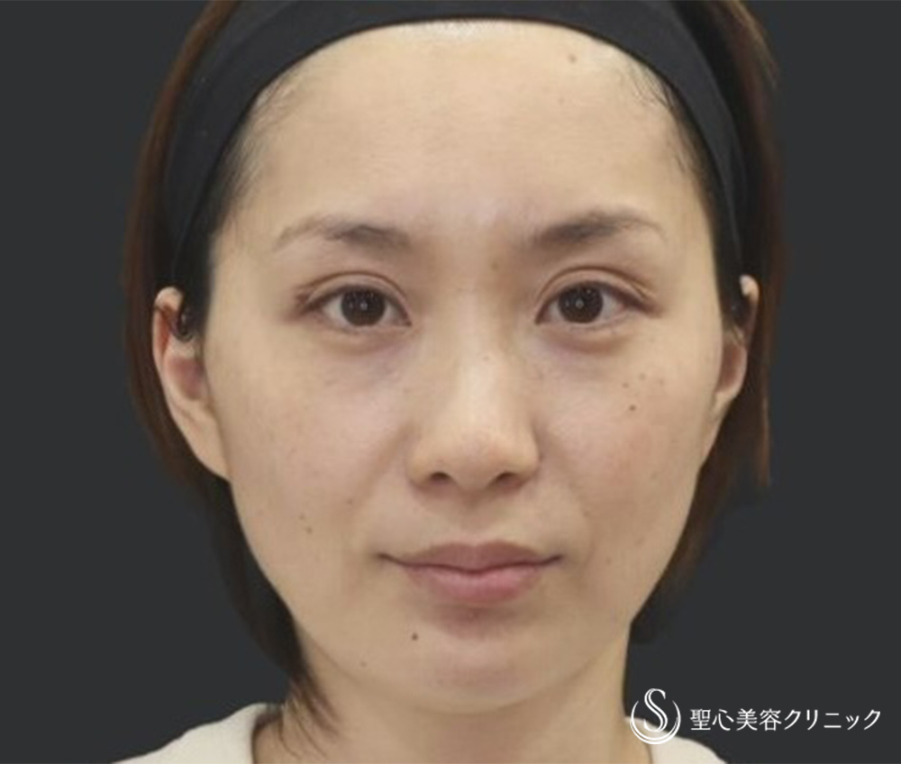 【30代女性・自然な若返り】プレミアムPRP再生療法（翌日～3ヶ月後） After 