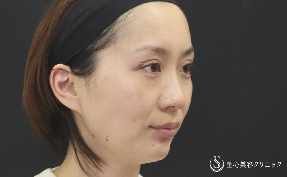 【30代女性・自然な若返り】プレミアムPRP再生療法（翌日～3ヶ月後） After 