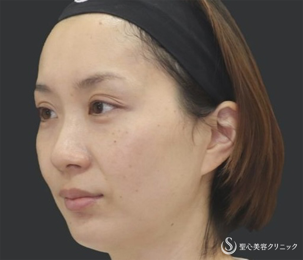 【30代女性・自然な若返り】プレミアムPRP再生療法（翌日～3ヶ月後） After 