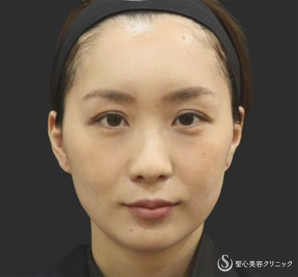 【30代女性・自然な若返り】プレミアムPRP再生療法（翌日～3ヶ月後） After 