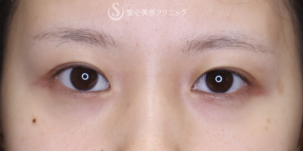 【20代女性・埋没法を卒業して一生モノの二重に】二重全切開（3ヶ月後） After 