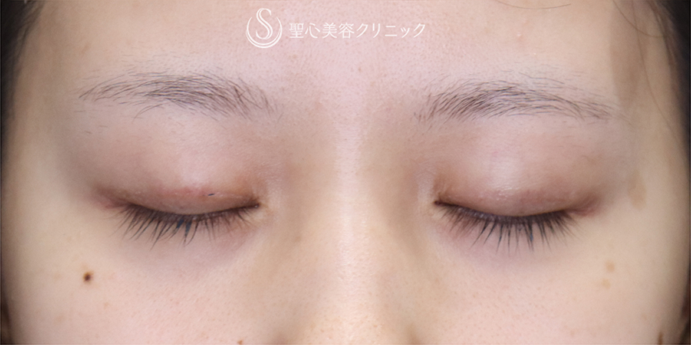 【20代女性・埋没法を卒業して一生モノの二重に】二重全切開（3ヶ月後） After 