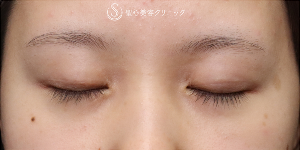 【20代女性・埋没法を卒業して一生モノの二重に】二重全切開（3ヶ月後） Before 
