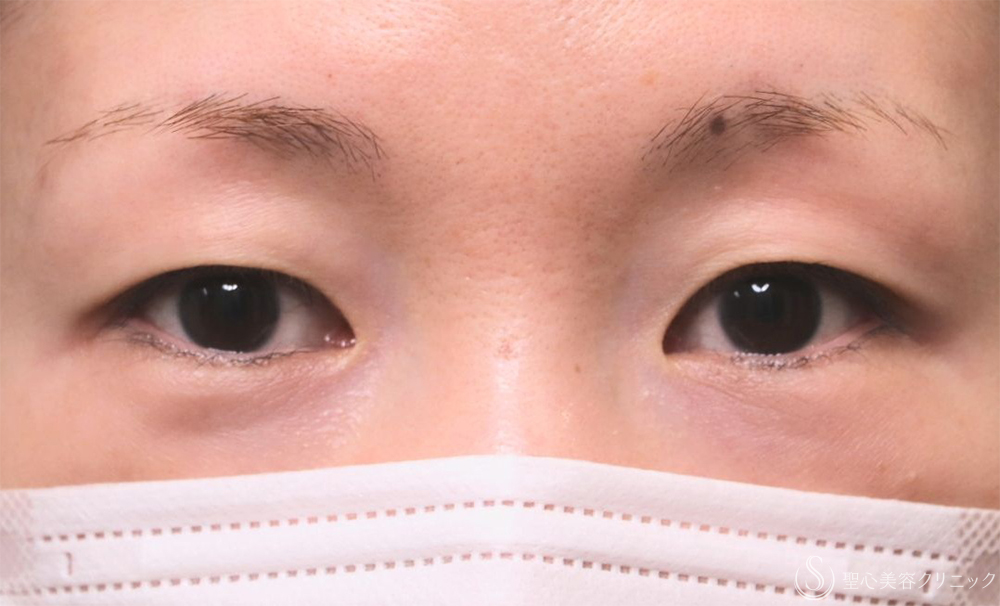 【30代女性・自然な二重に】  二重術（切開法）部分切開/全切開（3年後） Before 