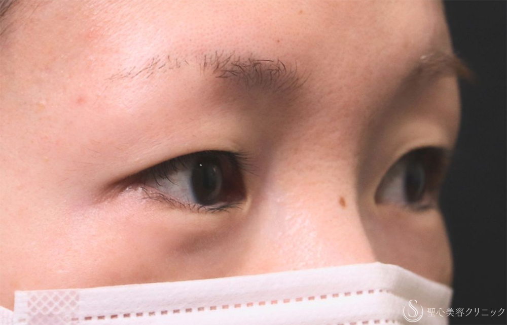 【30代女性・自然な二重に】  二重術（切開法）部分切開/全切開（3年後） Before 