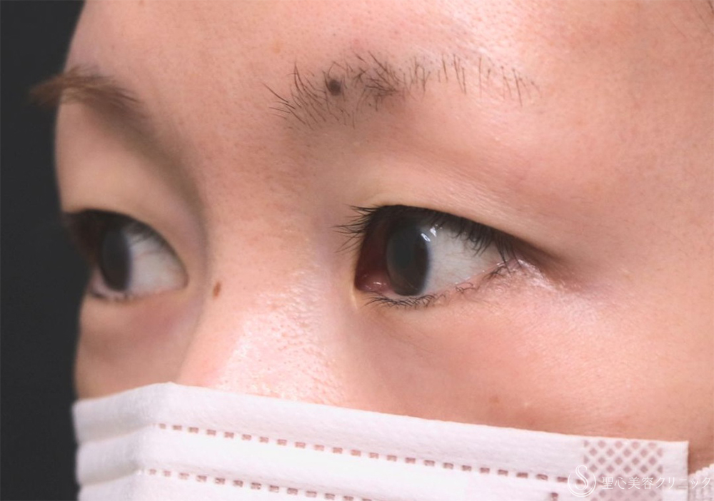 【30代女性・自然な二重に】  二重術（切開法）部分切開/全切開（3年後） Before 