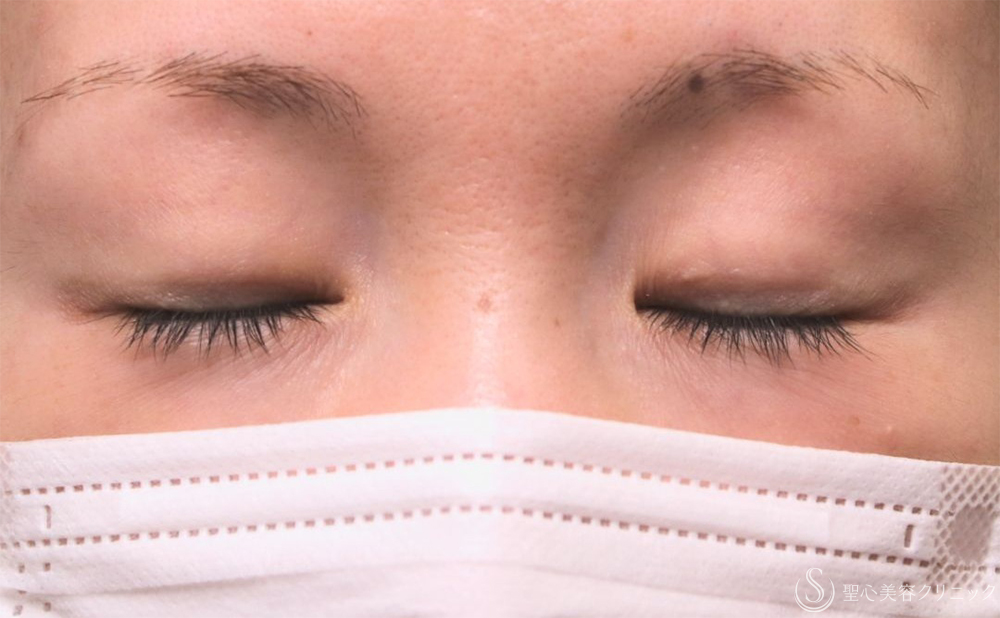 【30代女性・自然な二重に】  二重術（切開法）部分切開/全切開（3年後） Before 