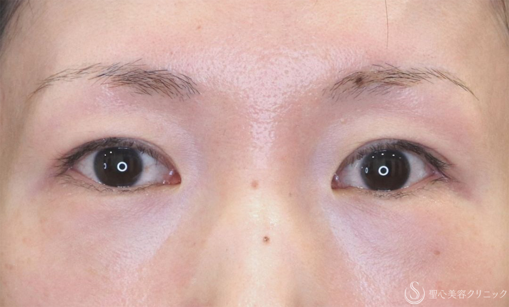 【30代女性・自然な二重に】  二重術（切開法）部分切開/全切開（3年後） After 